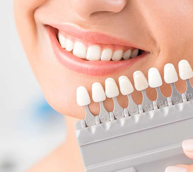 Bronx Dental Veneers and Dental Laminates